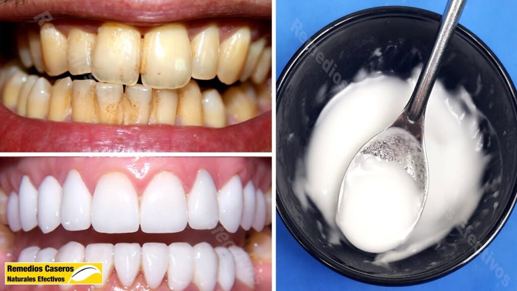 Cómo quitar las manchas amarillas de los dientes remedios caseros