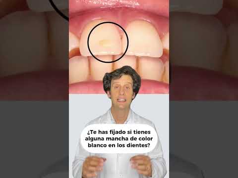 Cómo quitar las manchas de calcio en los dientes