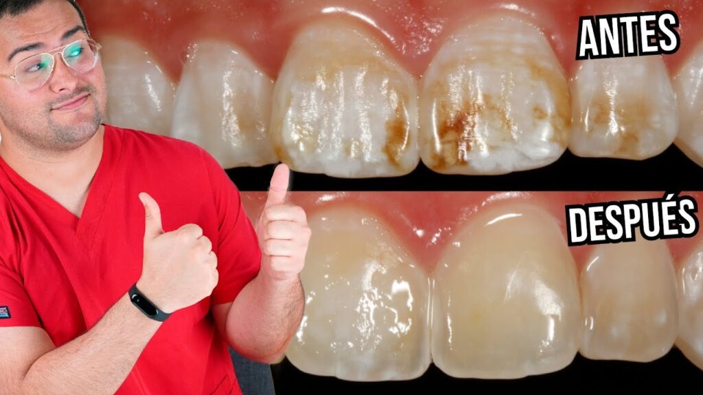 Cómo quitar las manchas de los dientes